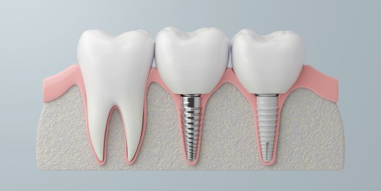 Welche Vorteile hat Zahnersatz aus Vollkeramik?