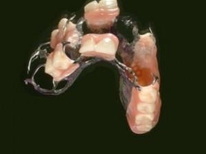 Ohne gaumenplatte oberkiefer highclenovfan: Zahnprothese
