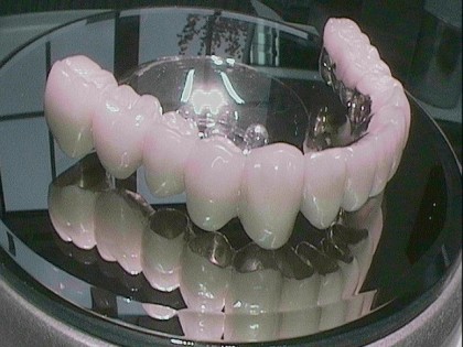 Oberkiefer gaumenplatte zahnprothese ohne Herausnehmbarer Zahnersatz