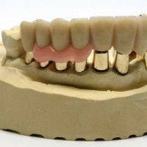 Ohne gaumenplatte oberkiefer highclenovfan: Zahnprothese